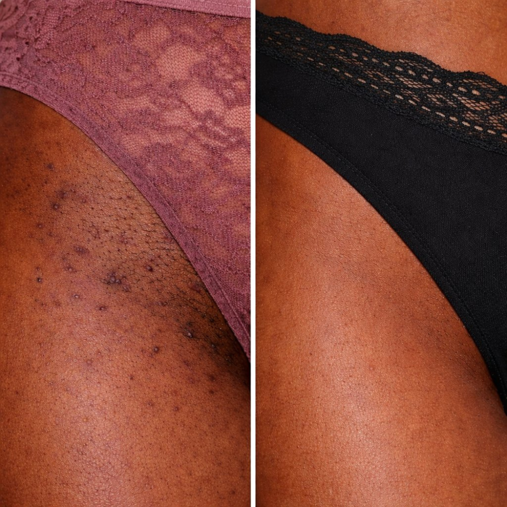 Bikini Line Bump & Dark Mark Serum — Gentle 15% Mandelic Acid