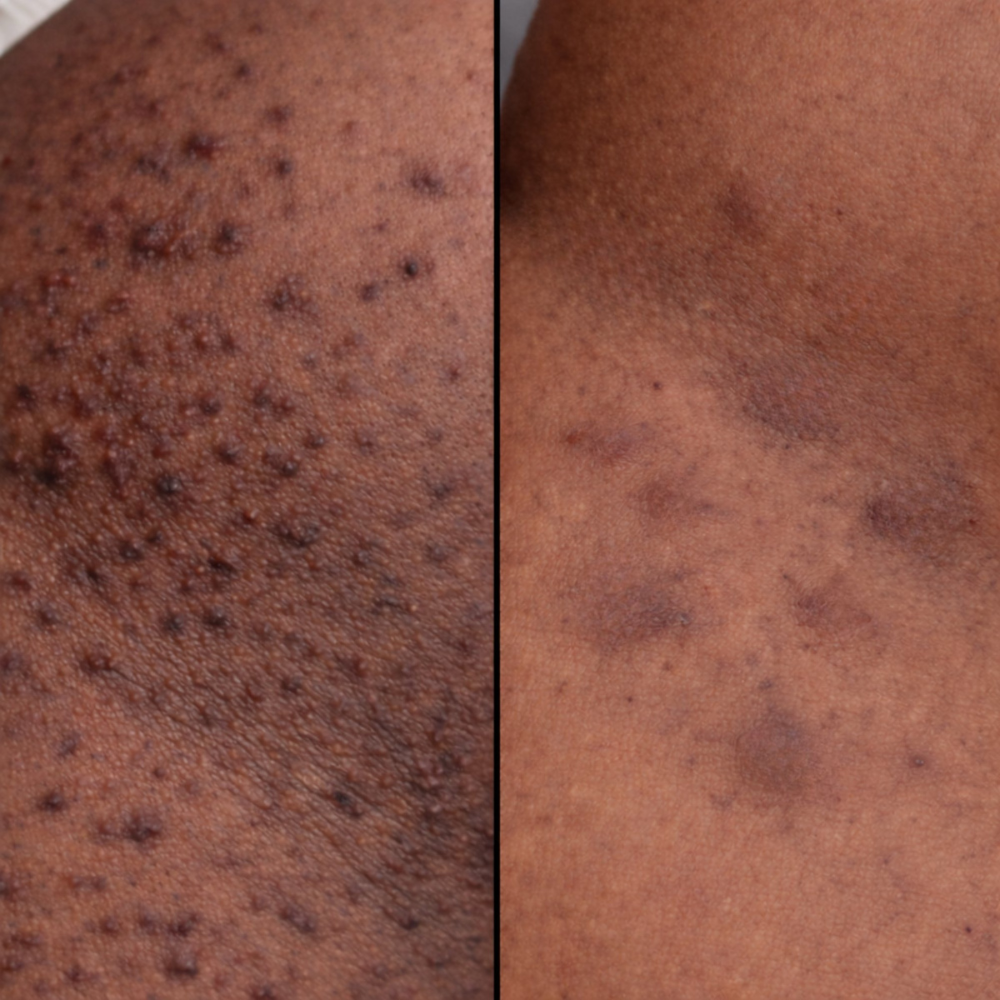 Bikini Line Bump & Dark Mark Serum — Gentle 15% Mandelic Acid